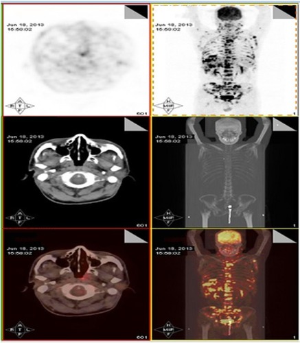 Figure 1 PET/CT (June 18, 2013) showing disease extent after first-line chemotherapy.