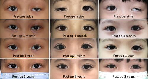 Figure 1 Preoperative and postoperative photographs of patients with successful surgical outcomes. These patients demonstrated both excellent functional and symmetrical cosmetic outcomes with a favorable eyelid margin contour.