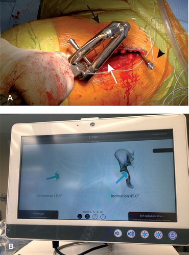 Figure 4. A. Implantation of the acetabular component with conventional cup applicator equipped with holder (white arrow) for measuring sensor (black arrow). Reference sensor (black arrowhead).B. Monitor with real-time information on acetabular component position.