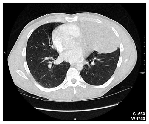 Figure 2. Computer tomographic scan of a 31-y-man with primary pulmonary primitive tumor (PNET) in the left lung.