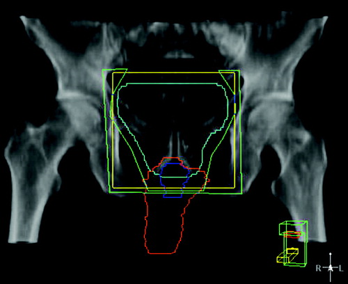 Figure 1.  Example of an anterior-posterior radiation field (yellow) with shaped blocks (green) and its relation to the penile bodies (red) and penile bulb (blue).