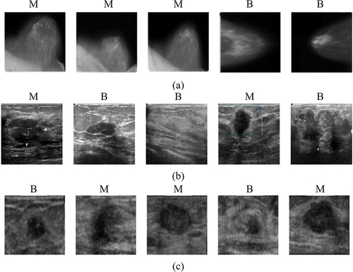 Figure 2. Some random image samples from the mammogram and sonogram datasets were considered in our study. benign and malignant images from (a) DDSM dataset, (b) BUSI dataset and (c) the BUSM dataset. (M is malignant and B is benign).