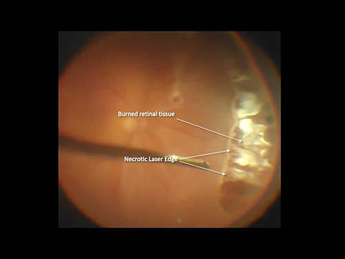 Figure 5 Large, oval necrotic defect in previously normal retina, extending from 2 to 5 o’clock, one week after encircling endolaser treatment during RRD repair, necessitating subsequent reoperation with application of a high external scleral buckle. Courtesy of Retina Specialists of Alabama, LLC.