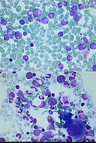 Figure 1 Microscopic view of the bone marrow aspirate.