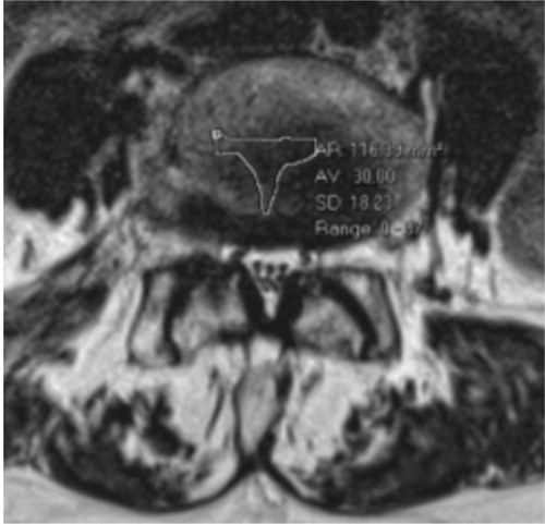 Figure 7. A trefoil spinal canal can predispose for lateral recess stenosis.