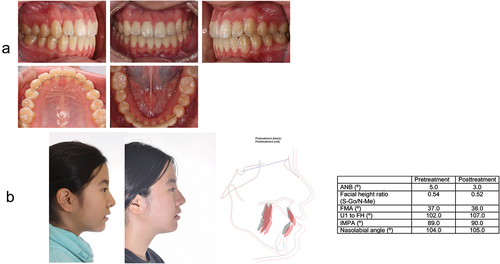 Figure 7. Retention: Intraoral and facial photographs, comparison of pre-treatment and 5 year retention with lateral cephalometric superimposition and measurements (a and b).