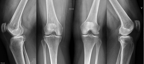 Figure 2. Patient number 5 in the supplementary data table. (A) The right knee with tibiofemoral and femoropatellar Kellgren and Lawrence (KL) grade 2/osteophyte. (B) The left knee with tibiofemoral KL grade 1 and femoropatellar KL grade 0.