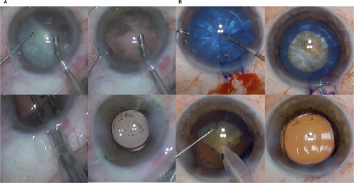 Figure 5 (A and B) Phacoemulsification performed in the usual manner, after using the automated technique and with the intraocular lens inside the capsular bag.