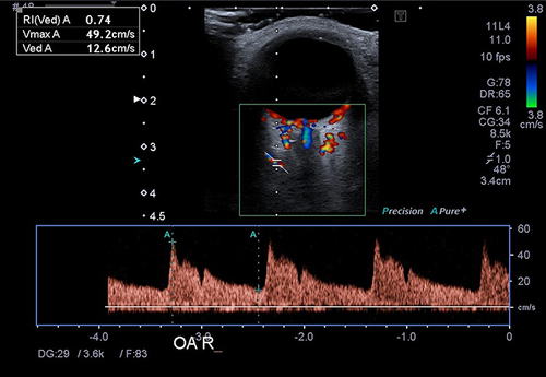 Figure 1 Blood flow spectrum of ophthalmic artery in Colour Doppler Imaging.