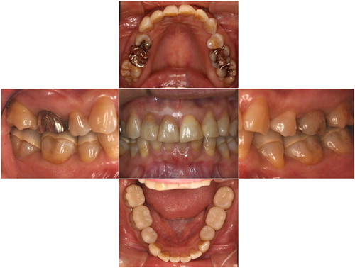 Figure 10. Intraoral photos taken at the 23-year follow-up.