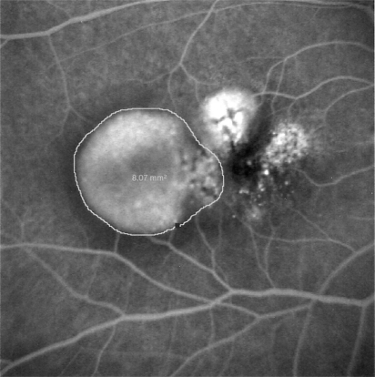 Figure 1 Fundus fluorescein angiography of case 1. The DEP area is measured in mm2.