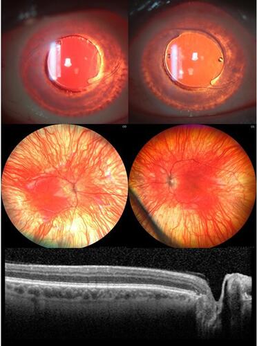 Figure 2 Iris transillumination defect, albinotic fundus and foveal hypoplasia in pseudophakic eyes of a 41-year-old patient. Note that major retinal blood vessels show a relatively wide exit angle as they emerge from the optic disc.