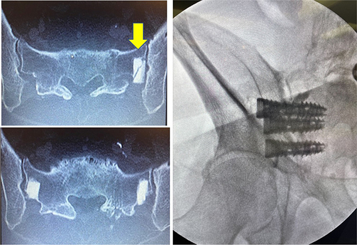 Figure 7 (Case 6). CT scan showed suboptimal positioning and fracture of one SA (yellow arrow). Patient underwent staged SIJ fusion surgery using porous titanium implants with complete resolution of symptoms.