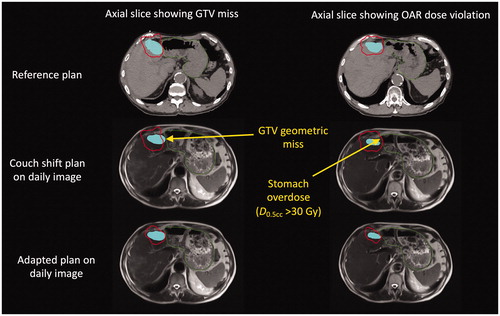 Figure 4. Anatomical deformation of the liver in a single patient between the reference plan and representative treatment fraction (third) leads to geometric target miss and OAR overdose in different regions. Top: two different axial slices of the reference CT image showing the 32 Gy isodose line (stomach dose constraint) conforming to the interface between the stomach (green contour) and GTV (blue shaded region). Middle/bottom: The same axial slices on the daily MR acquired at the third SBRT fraction, as determined by rigid registration showing the 32 Gy isodose line for the “couch shift” (middle) and adapted (bottom) plans. Because the interface is deformed (along with the daily re-contoured GTV), the couch shift results in a simultaneous geometric miss (left middle) as well as an OAR overdose (right middle).