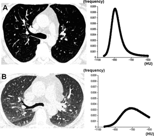 Figure 1  A 60-year-old male smoker with normal lung function (FEV1%predicted = 86%). Inspiratory (A) and expiratory (B) CT images and the density histograms are demonstrated. On the expiratory CT image (B), lung density increased particularly in dorsal parts of the bilateral lungs, resulting in heterogeneous lung density. Although inspiratory kurtosis and skewness are measured as 8.6 and 2.1, expiratory kurtosis and skewness decrease to 2.6 and 0.3. Note that the density histograms are obtained from all axial CT images that include the lung parenchyma, and not by a single image.