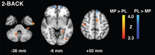 Figure 1 2-Back task group contrast maps for methylphenidate (MP) and placebo (PL) conditions in patients with post-stroke depression.