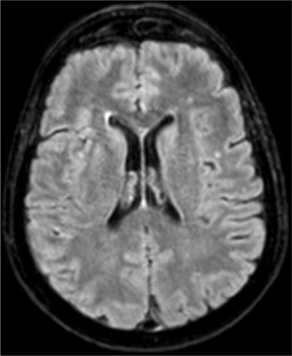 Figure 2 An Axial fluid-attenuated inversion recovery image obtained by magnetic resonance imaging (MRI) is reported. Note the moderate lesions in the frontal subcortical white matter and in semi oval centres of both sides.