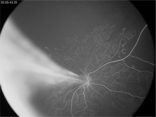 Figure 2 Fluorescein angiogram of a Wnt-associated vitreoretinopathy patient with an Fzd4 mutation.