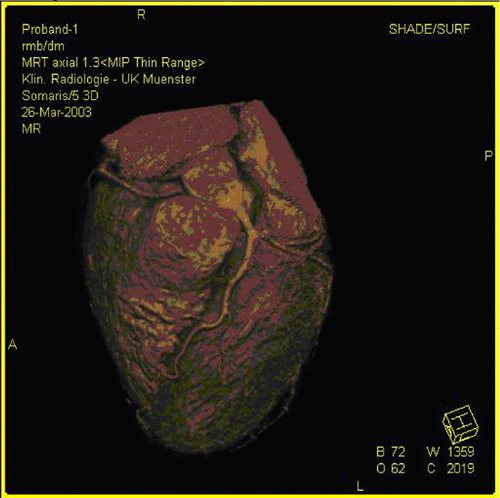 Figure 3. WH‐MRA‐surface shaded 3D‐reconstruction. (View this art in color at www.dekker.com.)