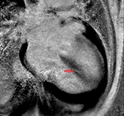 Figure 6 Streaky late gadolinium mid-myocardial enhancement in the septal wall, with small patchy late gadolium mid-myocardial enhancement in the inferior basal wall (red arrow).