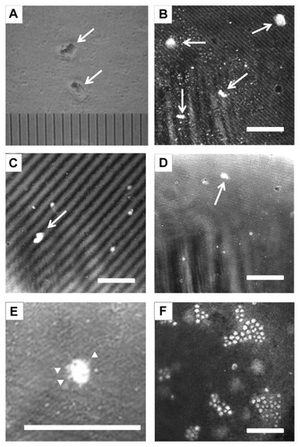 Figure 1 Light and confocal microscopic observation of cultured Acanthamoeba trophozoites. (A) Light microscopic observation of cultured Acanthamoeba trophozoites (arrows) (one scale = 10 μm). Note that the shape of the Acanthamoeba trophozoites was amorphous. (B) Ex vivo laser confocal microscopic observation of cultured Acanthamoeba trophozoites from Case 1. The Acanthamoeba trophozoites were observed as highly reflective, high-contrast amorphous structures. No walls were observed around the trophozoites (bar = 100 μm). (C) Ex vivo laser confocal microscopic observation of cultured Acanthamoeba trophozoites from Case 2 (bar = 100 μm). (D) Ex vivo laser confocal microscopic observation of cultured Acanthamoeba trophozoites from Case 6 (bar = 100 μm). (E) Acanthopodia (arrowhead), which are characteristic of Acanthamoeba trophozoites, were observed in some of the trophozoite images (Case 6) (bar = 100 μm). (F) Clusters of Acanthamoeba cysts were also observed as highly reflective, high-contrast stellate-shaped particles 10–20 μm in diameter (Case 2) (bar = 100 μm).