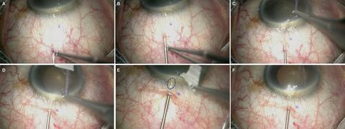 Figure 6 Key surgical steps of Transconjunctival ab externo XEN Gel Stent implantation: ring forceps lift conjunctiva prior to needle entry (A); needle track in the subconjunctival space (B); scleral entry at 2.5 mm from the limbus (C); the scleral track is created (D); the needle tip is visualized in anterior chamber [blue circle] (E); deployment of the Stent (F). Image courtesy of Won Kim, MD.