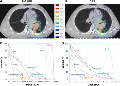 Figure 4 The dose distribution curves of a P-SABR plan (A) and comparative CRT plan (B). The isodose lines, from outer to inner, represent 20, 30, 40, 50, 57.2, 60, 69.2, 75, 81.2, and 85 Gy, respectively. The DVH of this P-SABR plan (C) and comparative CRT plan (D). Detailed dosimetric results including P-values are described in Tables 4 and 5.