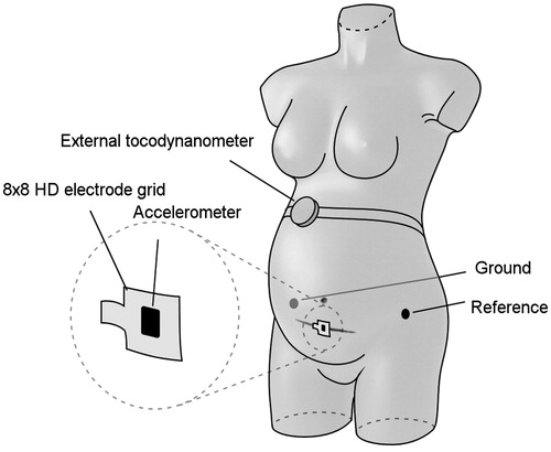 Figure 1. Positioning of the sensors on the maternal abdomen. The 64-channel electrode grid was positioned in the midline of the abdomen and centered over the scar. An external reference electrode was positioned on the left hip. In addition, an accelerometer was attached to the electrode grid and an external tocodynamometer was used.