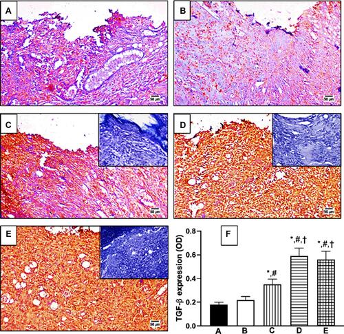 Figure 8 Effect of OFI-SNEDDS on expression of transforming growth factor-beta (TGF-β) by immunohistochemical staining. (A) Untreated Control; (B) Vehicle-treated Control; (C) OFI; (D) OFI-SNEDDS; (E) Positive Control. Negative photographs are put as inserts in their respective ones with strong positive reaction (C, D and E). (F) Quantitative image analysis for TGF-β immuno-histochemical staining, expressed as optical density (OD). Data are presented as Mean ± SD (n = 6). Statistical analysis was performed by one-way ANOVA followed by Tukey’s test. *Significant difference from Untreated Control group at p < 0.05. #Significant difference from vehicle-treated group at p < 0.05. †Significant difference from OFI group at p < 0.05.