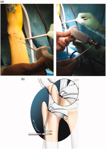 Figure 4. (a) Final fixation into the 2.5-mm predrilled bony canals in the ulna. Knotless fixation of the foveal TFCC reconstruction using 2.5 mm × 8 mm. Mini PushLock PEEK Suture Anchors using a hammer. Note: During this procedure, the tension on the arthroscopy traction tower must be lowered. (b) The final, knotless fixation of the fovea only TFCC injury.
