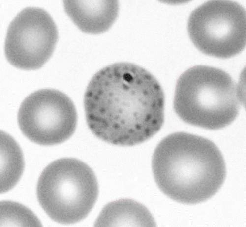 Fig. 1. Basophilic stippling. They could be seen in RBC of both patients.