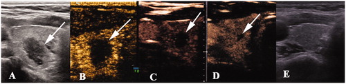 Figure 5. A 40 year-old woman with a papillary thyroid cancer in the right thyroid lobe. The images of the nodule pre- and post-ablation are shown. (A) A hypoechoic nodule (white arrow) with an irregular margin measuring 1.4 × 0.8 × 0.7 cm was detected in the right lobe. (B) One month after ablation, the ablation zone was 1.3 × 1.0 × 1.0 cm in size, which was larger in volume than that before ablation. (C–D) The ablation zone decreased gradually to 0.6 × 0.4 × 0.4 cm and 0.4 × 0.3 × 0.2 cm 3 and 6 months after ablation, respectively, and there was no enhancement on contrast-enhanced ultrasonography. (E) The ablation area disappeared on ultrasonography 12 months after ablation.