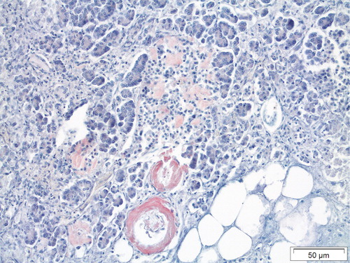 Figure 4. A modern pancreatic section from a patient with AA amyloidosis due to rheumatoid arthritis and with islet amyloidosis of IAPP nature. A similar colour difference as in Figure 3 is seen in the two amyloid forms. Congo red.