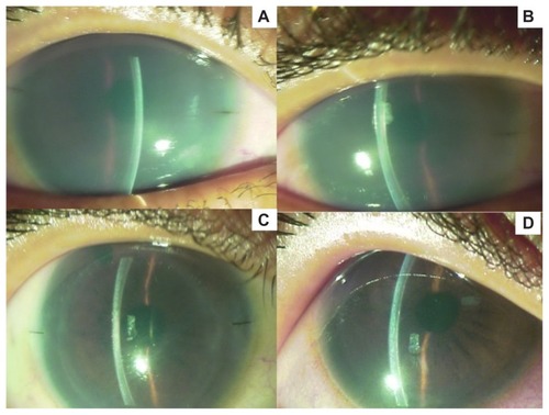 Figure 4 (A) postoperative appearance at 2 weeks; (B) postoperative appearance at 1 month; (C) postoperative appearance at 3 months; (D) postoperative appearance at 1 year.