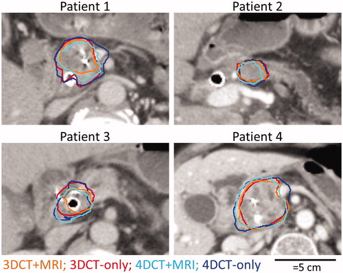 Figure 4. For each patient, median surfaces for CT + MRI study (orange and light blue in the online version) and the CT-only study (red and dark blue in the online version) are shown.