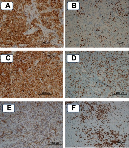Figure 1 Representative images of IHC staining. (A) PD-L1 expression status in the primary tumor (TPS≥50), (B) CD8+TIL count of the primary tumor (score 45), (C) PD-L1 expression status in the metastatic lymph node (TPS≥50), (D) CD8+TIL count in the metastatic lymph node (score 150), (E) PD-L1 expression status in the re-biopsy specimen (26≤TPS<50), (F) CD8+TIL count in the re-biopsy specimen (score 230).Abbreviation: TPS, tumor proportion score.