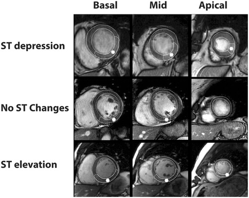 Figure 1. Representative CMR images of the three groups. Depicted sectors with asterixis indicate myocardium at risk. Top column shows case with ST depression, middle row no ST change, and bottom row, with ST elevation. Left column represents a basal slice, middle column mid ventricular slice, and right column apical slice.