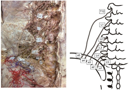 Figure 1 Photograph and the corresponding illustration showing five branches of the SCN on the left side of a specimen obtained from the cadaver of a 90-year-old woman (specimen no. 8). The most lateral branch (a5) had separate origins from the T12 and L2 nerve roots. The third most medial branch (a3) had separate origins from the L2 and L3 nerve roots.