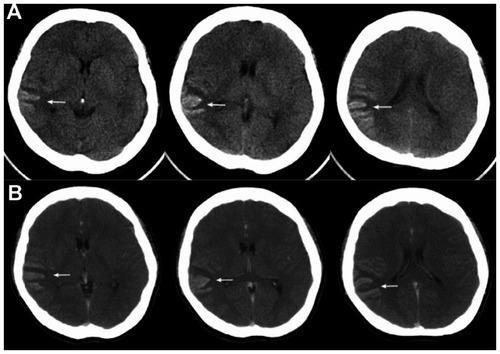 Figure 2 Case 2: brain computed topography (CT) without contrast (A) and postcontrast (B) showed hyperdense lesions with mild gyriform enhancement along the cortices of the right temporoparietal lobe.