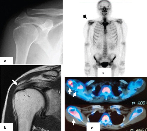 Figure 4. Case 2: A 51-year-old male with a rotator cuff tear in the right shoulder. No obvious osteoarthritis is observed in X-rays (A). A full-thickness rotator cuff tear was observed on the coronal T2 WI MRI (B, arrow). An increase of RI uptake in the left shoulder joint is observed in the bone scintigram (C, arrow). In SPECT images, RI uptakes are evident in the greater tuberosity of the humerus, the coracoid process of the scapula, and the glenohumeral joint (D, arrows).