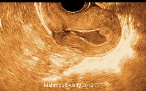 Figure 10 2D SHG image showing a sagittal section in 3rd degree RVF uterus with a markedly defective cesarean scar niche.