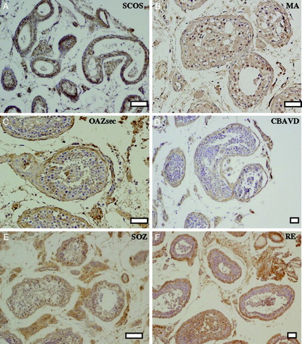 Figure 1.  Immunohystochemical detection of the CFTR protein in different pathologies of infertile patients. General architecture of the seminiferous tubules at low magnification. A) Sertoli cell only syndrome (SCOS), B) maturation arrest (MA), C) secondary obstructive azoospermia (OAZsec), D) congenital bilateral absence of the vas deferens (CBAVD), E) severe oligozoospermia (SOZ), and F) retrograde ejaculation (RE). Bars: 100 µm (A, E), 50 µm (B, C, D, F).