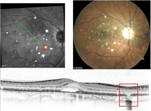 Figure 19 Fundus photographs (top) showing white lesions in the right eye of a patient with PIC; the B-scan line on the fundus photograph (top-left) has the same width as the B-scan SD-OCT image (bottom) demonstrating missing retinal layers in the area of the lesion.