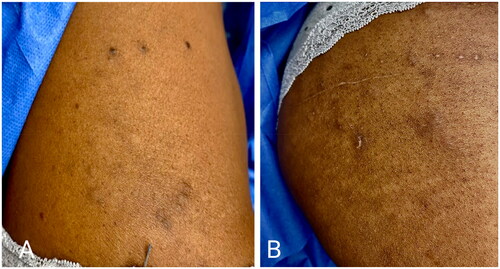 Figure 1. (A-B) Clinical Photographs of Eruptive Vellus Hair Cysts Subcutaneous nodules with overlying excoriations and hyperpigmentation on the trunk (A) and thighs (B).