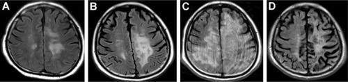 Figure 2 Changes in brain magnetic resonance imaging (FLAIR images).