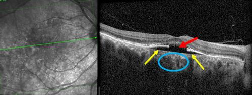 Figure 6 SD-OCT image of a patient with nonexudative AMD in which a PED developed with focal atrophy of the RPE at the crest of the PED (red arrow), but in which the Bruch’s membrane remained intact (yellow arrow). The subjacent choroid (blue oval) suffered no choroidal excavation. Destruction of the Bruch’s membrane is hypothesized to be a necessary precondition for FCE development in acquired cases.