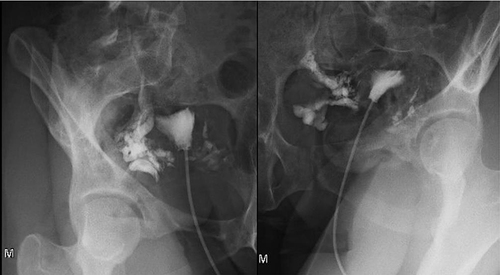 Figure 4 XR Right and Left Hysterosalpingography (March 2023).