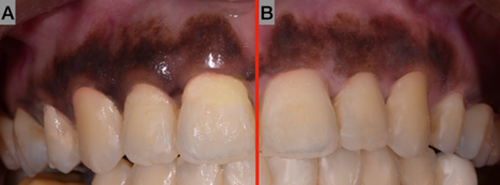 Figure 1 Comparative visualization of (A) non-polarized and (B) polarized images. Image (B) highlights the absence of flash reflection on the polarized side.