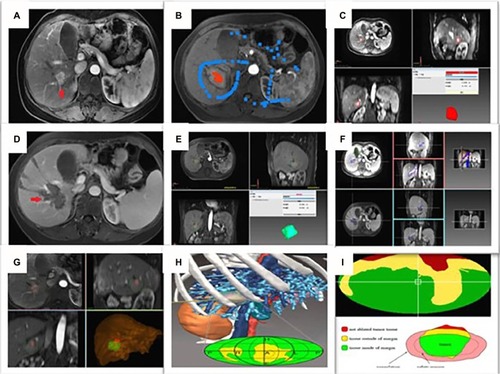Figure 3 Images in a 58-year-old-woman who underwent US-PMWA for hepatocellular carcinoma (HCC) (2.8 cm × 2.5 cm × 2.0 cm) assisted by 3D visualization of operative planning system.Notes: (A) Preoperative contrast-enhanced MRI showed the HCC with peripheral nodular hyper-enhancement in artery phase in right lobe accompanied with two feeding arteries (red arrows). (B) The HCC lesion was sketched as region of interest (ROI) in the tumor with red color and areas around the interest region were deleted. (C) Three-dimensional (3D) visualization of operative planning system showed the location and relationship with the tumor and the surrounding organs, and quantized the volume of liver and HCC (liver: 1,396.94 mL; HCC: 5.22 mL). (D) In the MRI, 3 days after ablation, ablation zone was demonstrated clearly in delay phase. (E) 3D visualization of operative planning system showed the location and relationship with the ablation zone and the surrounding organs, and quantized the volume of liver and ablation zone (liver: 1,291.32 mL; HCC: 36.00 mL). (F) Screen shots show the procedure for 3D visualization of imaging registration before and after ablation. The junction between the portal vein and the hepatic right vein was selected as an appropriate landmark (circle cross indicate). (G) The post-ablation 3D image (green color) was overlayed onto the preablation 3D image (red color). (H) A spherical parameterization of the surface was used in 3D visualization of operative planning system and subsequently flattened onto a 2D map. (I) A traffic light color scheme (red, green, yellow) was used to emphasize ablation state in tumor map.Abbreviations: US-PMWA, ultrasound-guided percutaneous microwave ablation; MRI, magnetic resonance imaging.