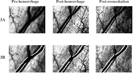 Figure 3. (A) Frame-captured images of the conjunctival microcirculation of the dog during 3 experimental phases in Hespan® resuscitation. (B) Same frame-captured images as in Figure 3A with identically-spaced white lines superimposed to illustrate the changes in venular diameter. (View this art in color at www.dekker.com.)